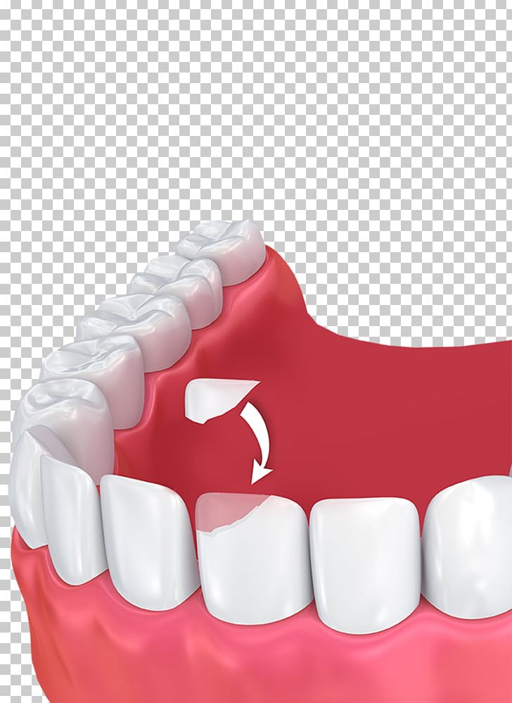 Human Tooth Dental Bonding Cosmetic Dentistry PNG, Clipart, Cosmetic Dentistry, Dental Bonding, Dental Implant, Dental Restoration, Dental Surgery Free PNG Download