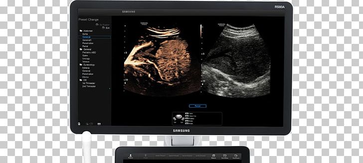Contrast Agent Ultrasonography Ultrasound Radiography Medical Imaging PNG, Clipart, Blood Vessel, Computed Tomography, Computer Monitor, Contrast Agent, Contrastenhanced Ultrasound Free PNG Download