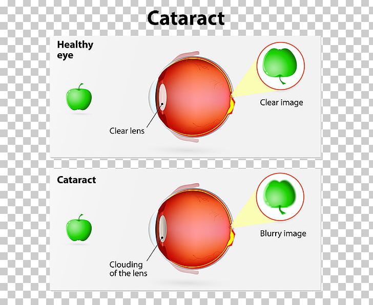 Cataract Surgery Intraocular Lens Human Eye PNG, Clipart, Agerelated Eye Disease Study, Area, Brand, Cataract, Cataract Surgery Free PNG Download