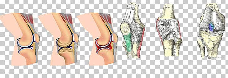 Arthritis Pain Osteoarthritis Rheumatoid Arthritis Joint Pain PNG, Clipart, Arm, Arthritis, Arthritis Pain, Body Jewelry, Disease Free PNG Download