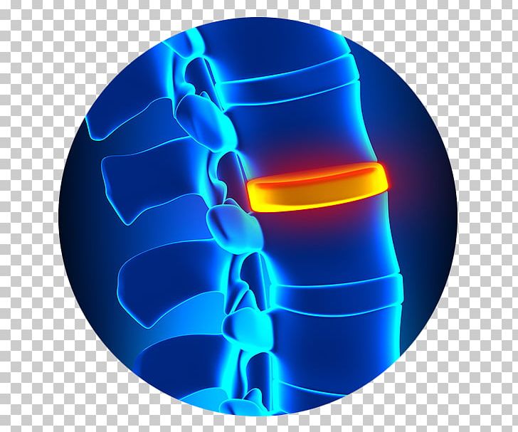 Spinal Disc Herniation Degenerative Disc Disease Vertebral Column Orthopedic Surgery PNG, Clipart, Ache, Chiropractic, Disc, Discitis, Electric Blue Free PNG Download