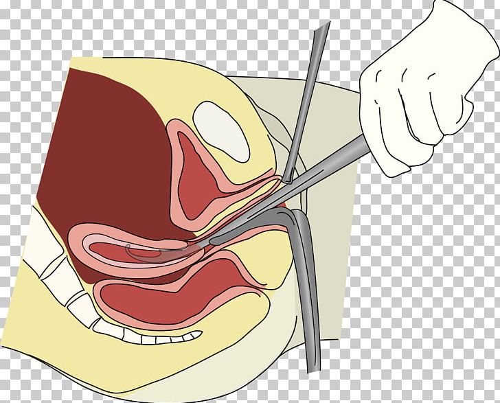 Medical Abortion Surgery Vacuum Aspiration Dilation And Curettage PNG, Clipart, Abortion, Abortion Instrument Cliparts, Arm, Art, Cartoon Free PNG Download