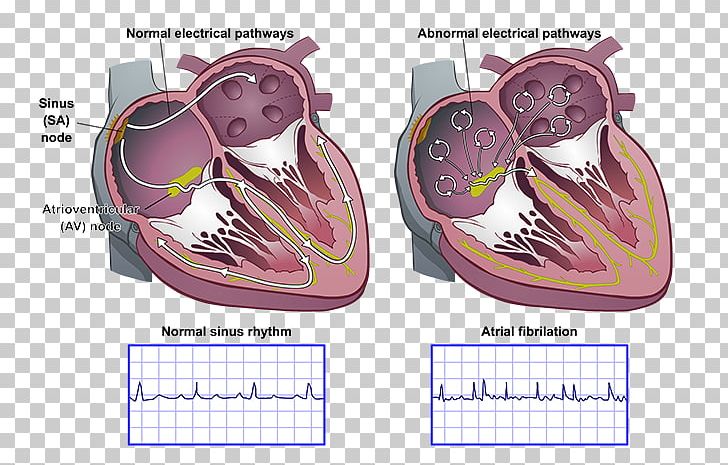 Heart Arrhythmia AV Nodal Reentrant Tachycardia Atrial Fibrillation Sinoatrial Node Atrium PNG, Clipart, Atrial Fibrillation, Atrium, Av Nodal Reentrant Tachycardia, Calendar, Cardiology Free PNG Download