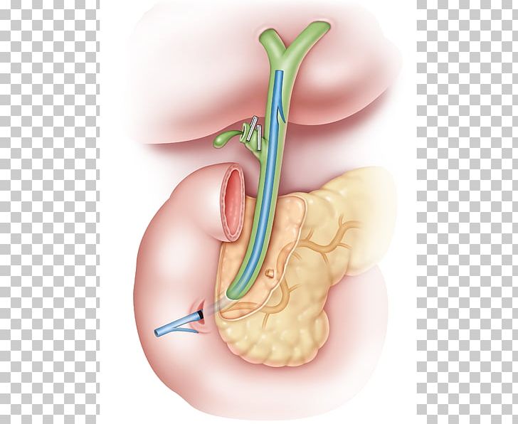 Stenting Common Bile Duct Gallbladder PNG, Clipart, Bile, Bile Duct, Bowel Obstruction, Common Bile Duct, Ear Free PNG Download