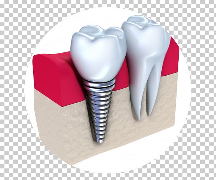 Dental Implant Dentistry Dentures PNG, Clipart, Allon4, Bridge, Cosmetic Dentistry, Crown, Dental Implant Free PNG Download