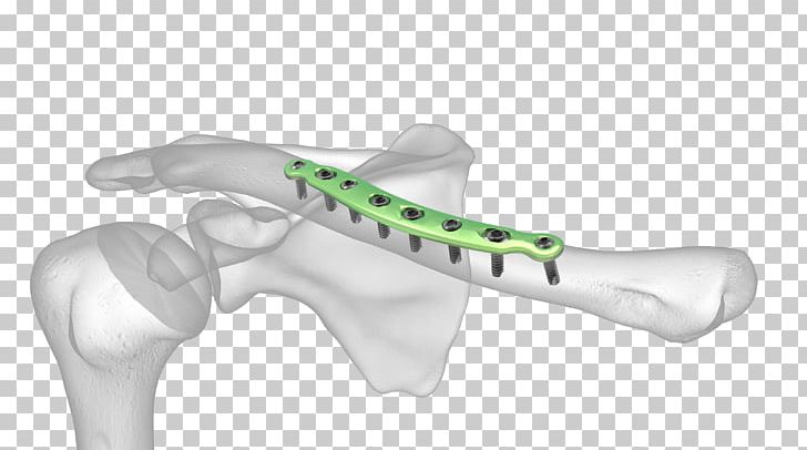 Clavicle Fracture Bone Fracture Surgery Internal Fixation PNG, Clipart, Acromioclavicular Joint, Bone, Bone Fracture, Clavicle, Clavicle Fracture Free PNG Download