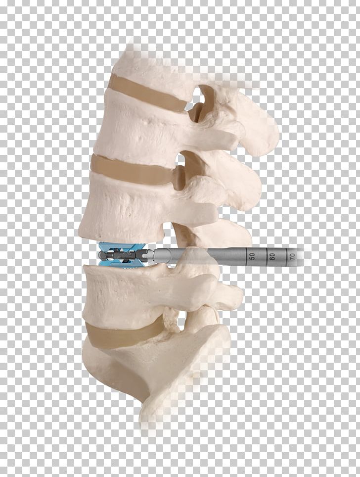 Spinal Fusion Vertebral Column Spinal Decompression Human Back Lumbar PNG, Clipart, Bone, Decompression, Discectomy, Douglas, Fusion Free PNG Download