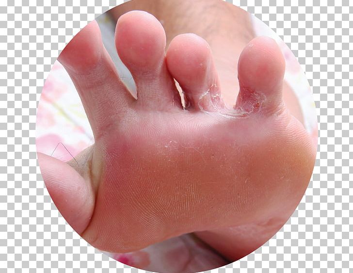 Athlete's Foot Ringworm Infection Mycosis PNG, Clipart,  Free PNG Download