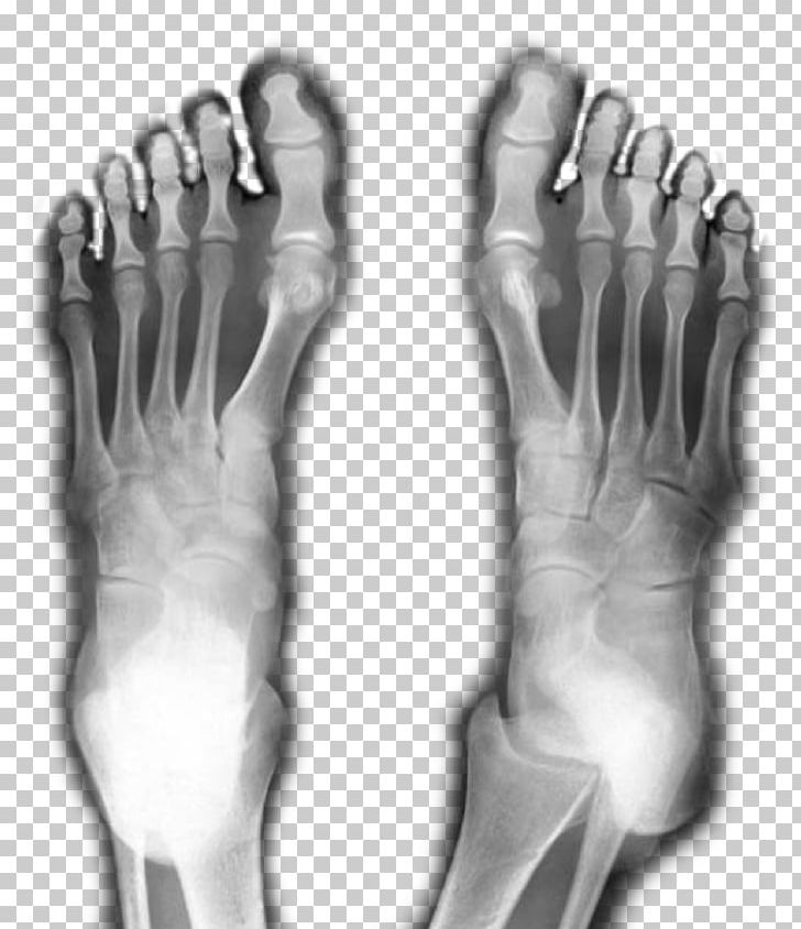 Thumb Podiatry Foot Surgery Ankle PNG, Clipart, Accurate, Arm, Black And White, Bone, Diagnosis Free PNG Download