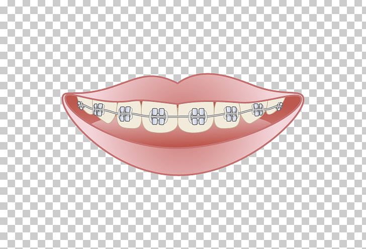 矯正歯科 Dentist Dental Braces Mouthguard Damon System PNG, Clipart, Clinic, Damon System, Dental Braces, Dentist, Dentistry Free PNG Download