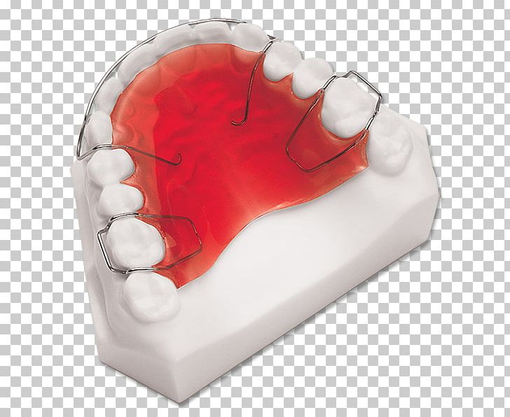 Retainer Orthodontics Dentistry Dental Laboratory PNG, Clipart, Appliances, Clear Aligners, Dental, Dental Braces, Dental Implant Free PNG Download