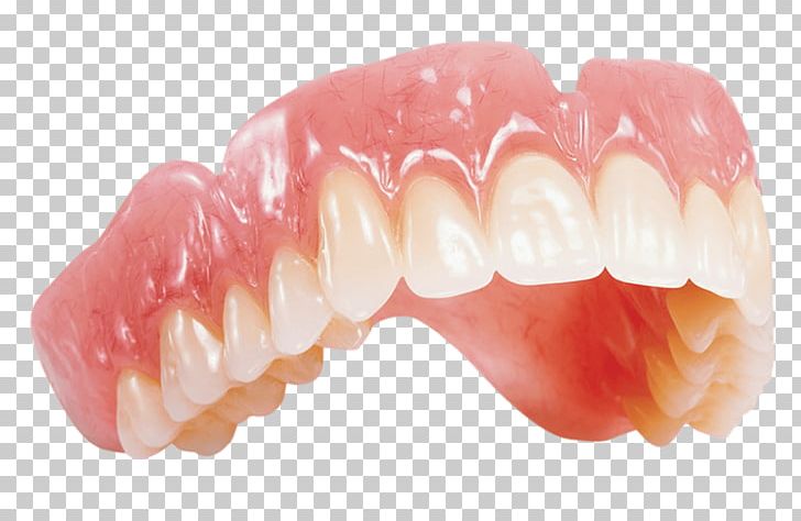 Dentures Removable Partial Denture Dentistry Dental Laboratory Crown PNG, Clipart, Bridge, Chewing Gum, Crown, Dental Implant, Dental Laboratory Free PNG Download