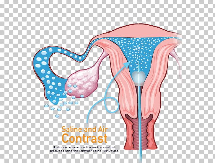 Fallopian Tube Ultrasonography Infertility Uterus Hysterosalpingography PNG, Clipart, Contrast Agent, Fallopian Tube, Gynaecology, Human Body, Hysterosalpingography Free PNG Download
