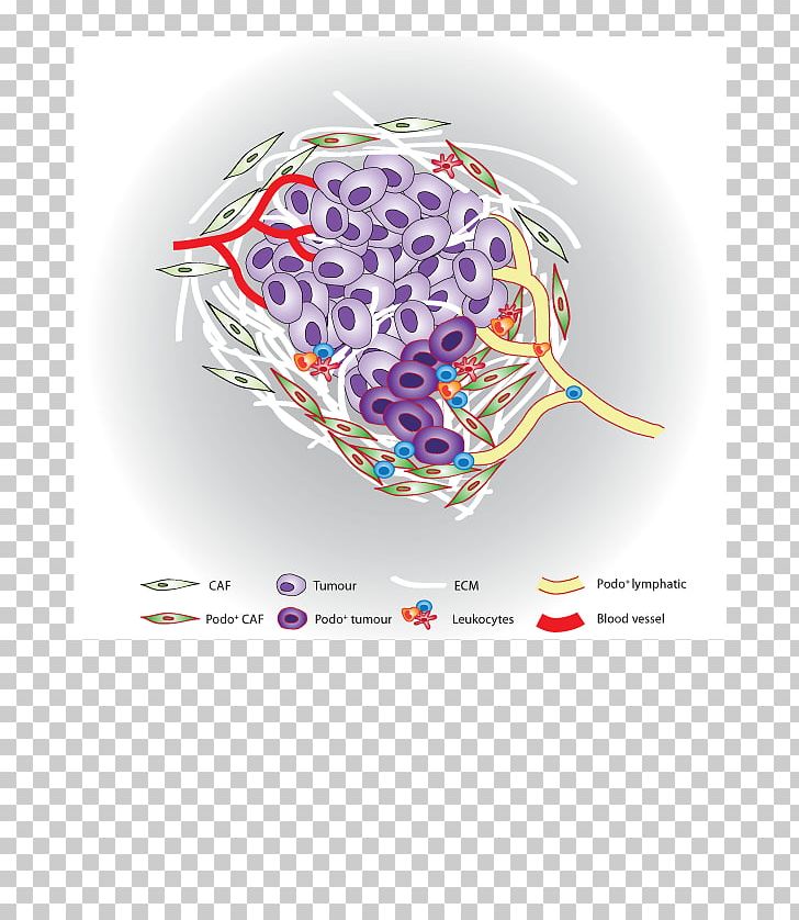 Stromal Cell Cancer Tumor Microenvironment PNG, Clipart, Bladder Cancer, Breast Cancer, Cancer, Cancer Cell Of Globular Pathogen, Cancer Immunotherapy Free PNG Download