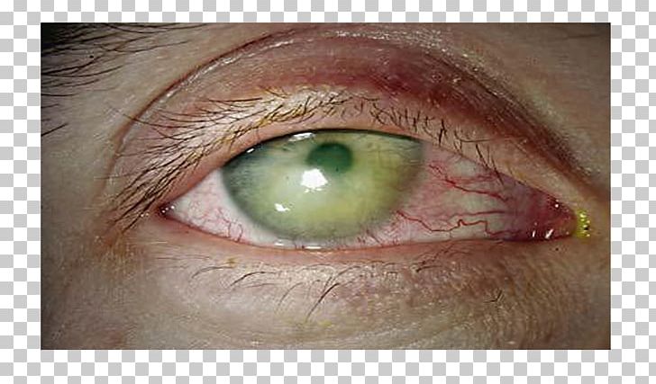 Iris Dry Eye Syndrome Corneal Abrasion PNG, Clipart, Closeup, Cornea, Corneal Abrasion, Dermoid Cyst, Diplopia Free PNG Download