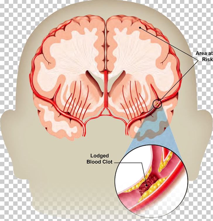 Stroke Transient Ischemic Attack Neurology Brain Haemorrhage Health PNG, Clipart, Basal Ganglia, Bleeding, Blood, Blood Pressure, Blood Vessel Free PNG Download