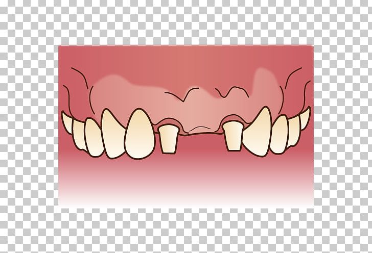 Tooth Dentures Dentist 歯科 Bridge PNG, Clipart, Bridge, Dental Braces, Dental Implant, Dental Technician, Dentist Free PNG Download