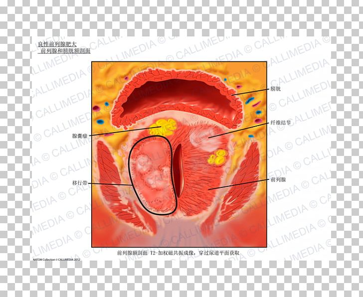 Prostate Anatomy Urinary Bladder Magnetic Resonance Imaging Hypertrophy PNG, Clipart, Anatomy, Benign Prostatic Hyperplasia, Benign Tumor, Bladder Cancer, Ear Free PNG Download