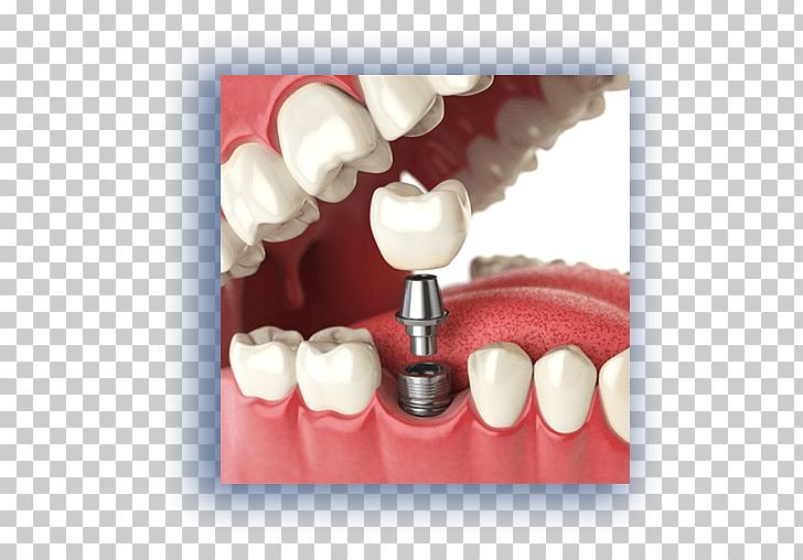 Dental Implant Dentistry Tooth Loss PNG, Clipart, Allon4, Crown, Dental Implant, Dental Restoration, Dentist Free PNG Download