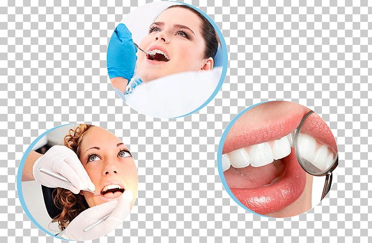 Dentistry Tooth Whitening Dental Implant Endodontic Therapy PNG, Clipart, Cheek, Chin, Clinic, Cosmetic Dentistry, Dental Implant Free PNG Download