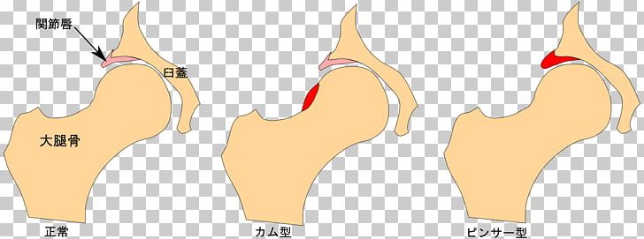 Finger Femoroacetabular Impingement Hüftgelenk Acetabulum Femur PNG, Clipart, Ace, Acetabulum, Arm, Bone, Cartilage Free PNG Download