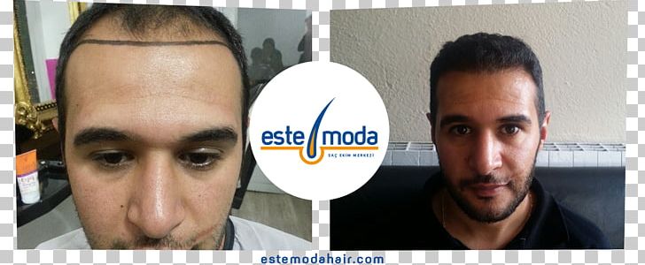 Este Moda Hair Saç Ekim Merkezi Hair Transplantation Eyebrow Capelli PNG, Clipart, Adana, Capelli, Chin, Eyebrow, Face Free PNG Download