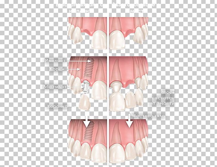 Tooth Cosmetic Dentistry Dental Implant Bruxism PNG, Clipart, Ache, Anesthesia, Bruxism, Cosmetic Dentistry, Dental Implant Free PNG Download