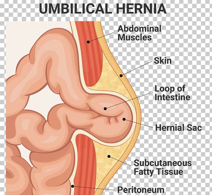 Umbilical Hernia Hernia Repair Inguinal Hernia Surgery PNG, Clipart, Abdomen, Angle, Arm, Babies, Cartoon Free PNG Download