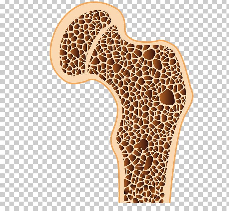 Osteoporosis Bone Density Osteopenia Bone Disease PNG, Clipart, Bone, Bone Cyst, Bone Density, Bone Disease, Bone Fracture Free PNG Download