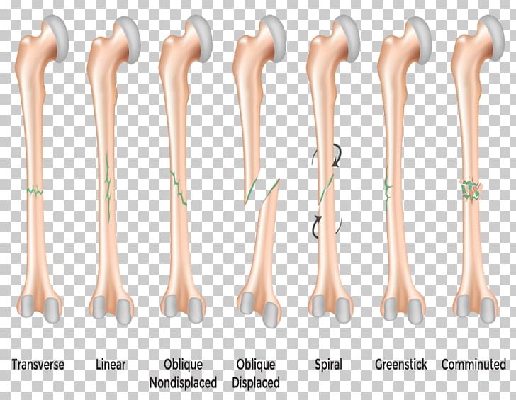 Bone Fracture Greenstick Fracture Stress Fracture Hip Fracture PNG, Clipart, Ache, Ankle Fracture, Arm, Bone, Bone Fracture Free PNG Download